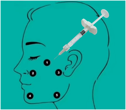 gel ácido hialurónico ácido hialurónico ligado cruz del llenador de 32mg H-HA L-HA no