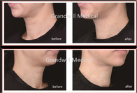 El cuello del hospital alinea el relleno del ácido hialurónico 1ml que quita las arrugas finas del cuello