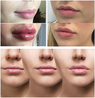 Líneas lisas/labios regordetes con el llenador inyectable ácido hialurónico 1ml 2ml 5ml