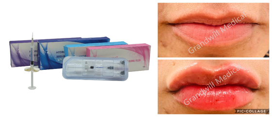 5 ml Relleno para labios Gel de inyección de ácido hialurónico Relleno botella jeringa Envase Tratamientos de arrugas faciales