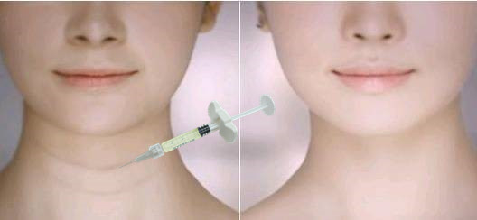 Obtener labios más largos con rellenos de labios dérmicos Líneas del cuello Rellenos de arrugas de la cara Rellenos
