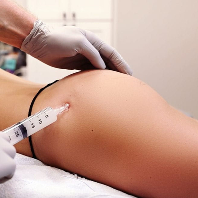 Relleno de labios de aspecto natural Ácido hialurónico inyectable