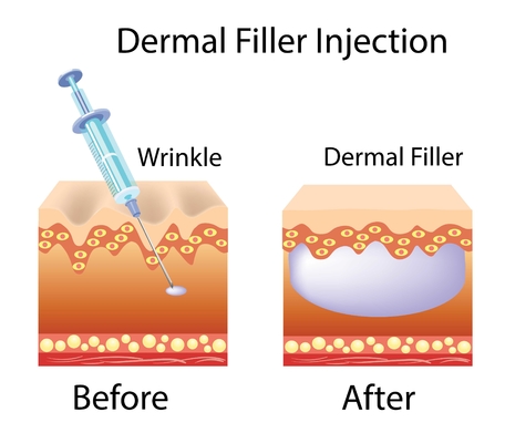 Fabricante de relleno de ácido hialurónico Gel modificado de hialuronato sódico inyectable para la cara y el cuerpo