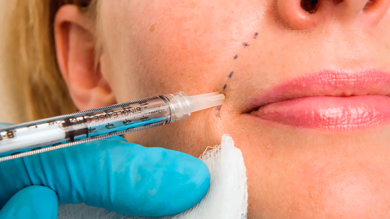 50 ml de Hyaluronic Acid Dermal Facial Chin Filler inyectable con Lidocaína PCL Plla Filler para inyección