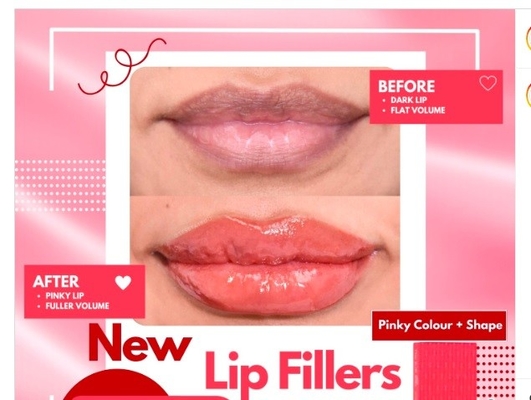 Efectivos rellenos cutáneos para los labios Inyecciones de ácido hialurónico en los labios para aumentar la masa de los labios rojos