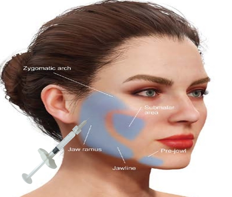 Ácido hialurónico HA Calcio Hidroxiapatita Relleno Obtener rostro de aspecto natural con una jeringa de 1 ml