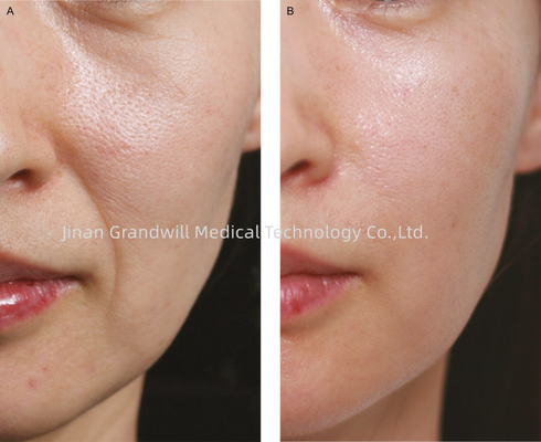 Miracle H L PCL Skin Booster Línea fina de policaprolactona para inyección de ácido hialurónico