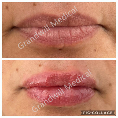Llenador cutáneo ácido hialurónico inyectable 1ml 2ml del gel del aumento del labio