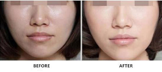 Sodio ligado no cruzado Hyaluronate que rejuvenece la inyección para el cuidado de piel