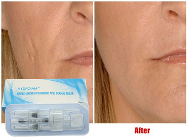 Llenador inyectable ácido hialurónico 10ml para las mejillas Chin Augmentation de la inyección del labio