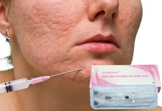 inyección del gel de Hyaluronate del sodio 1ml para quitar arrugas faciales finas