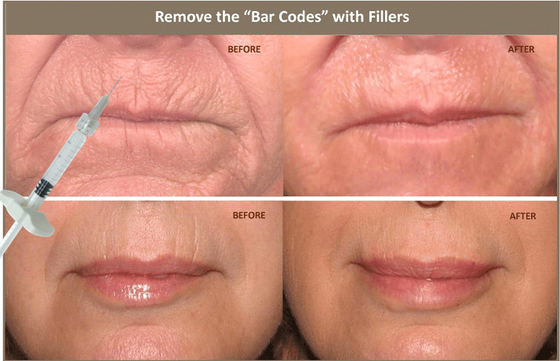 llenador cutáneo ácido hialurónico inyectable 10ml para corregir asimetría facial
