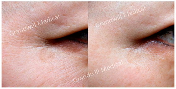 Cuidado de piel cutáneo del llenador del lifting facial PCL que levanta apretando el colágeno estimulante