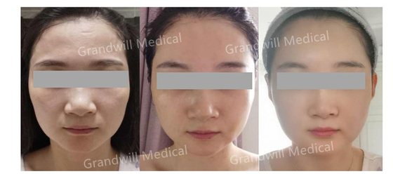 El milagro cutáneo del llenador de la ha PCL del lifting facial toca para arriba la inyección de Microneedling