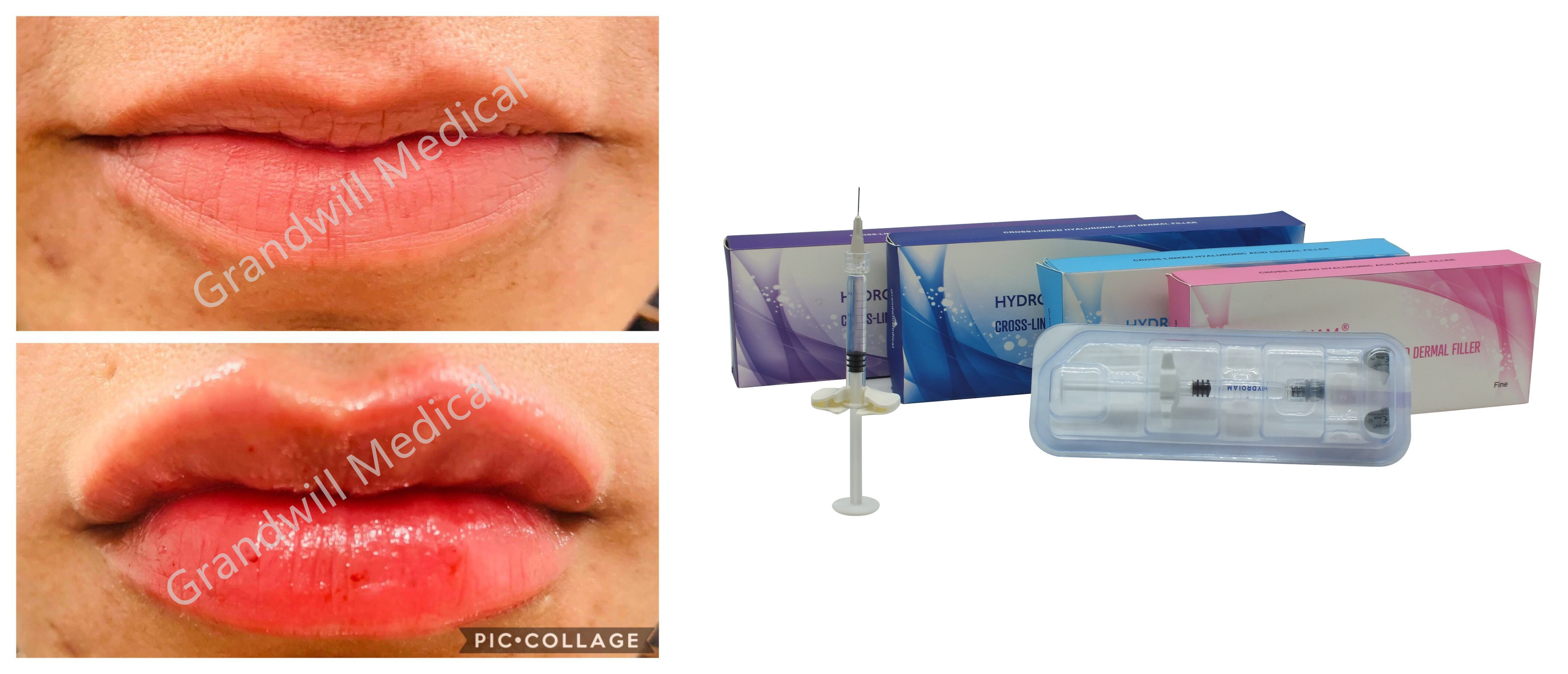 Llenador cutáneo ácido hialurónico ligado cruzado de la inyección del sodio para las arrugas faciales de la plenitud del labio