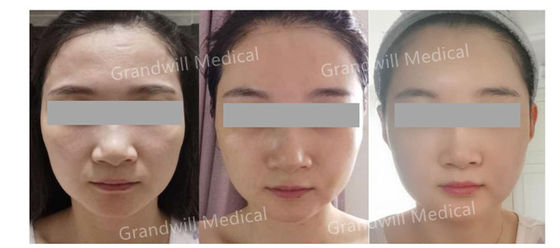 Relleno dérmico estéril de ácido hialurónico reticulado diseñado para el contorno facial de aspecto natural y el rejuvenecimiento de la piel