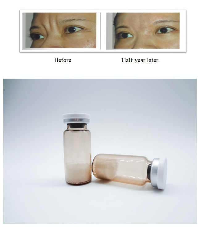 Gel inyectable para la piel facial no animal Acido hialurónico basado para el tratamiento seguro de arrugas y restauración del volumen